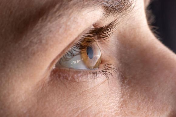 a person with corneal cross linking in her eye